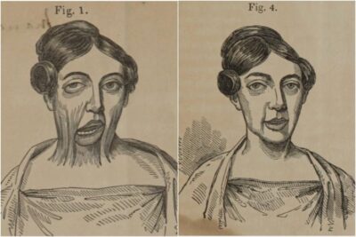 Illustration of burn victim before and after surgery